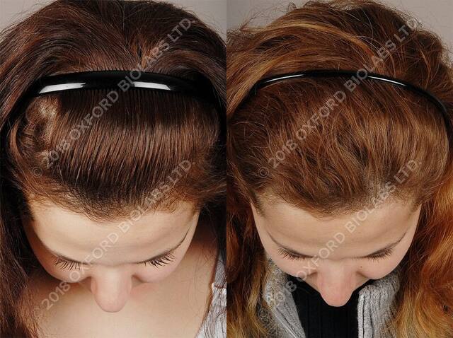 TRX2® before and after results