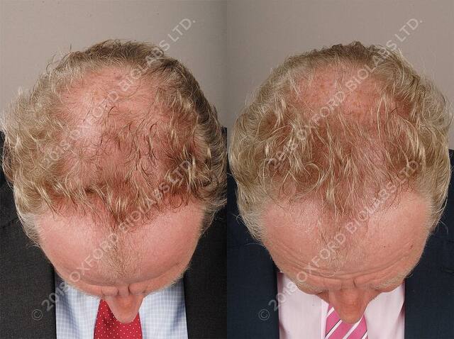 TRX2® before and after results