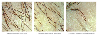 Mepilarin Case 3
