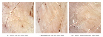 Mepilarin case 5
