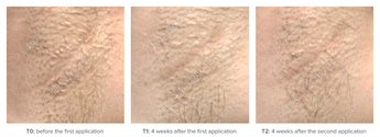 Mepilarin Case 1