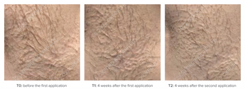 Mepilarin Case 2
