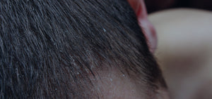 Understanding Dandruff: Causes and Treatments