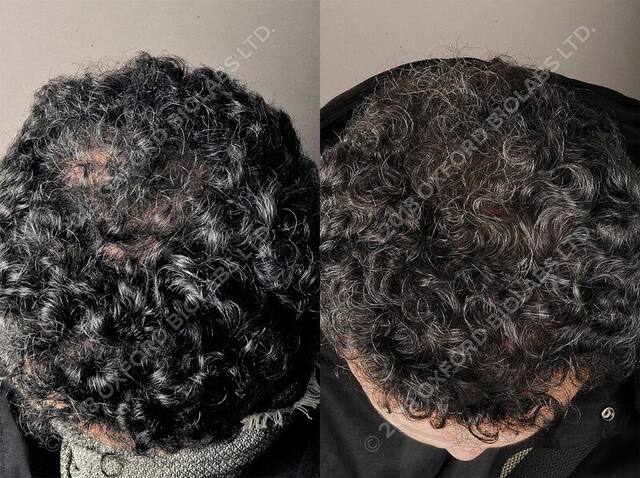 TRX2® before and after results