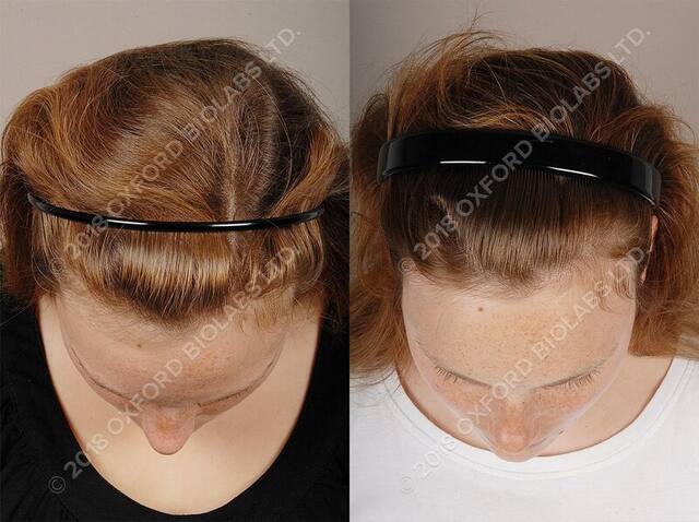 TRX2® before and after results