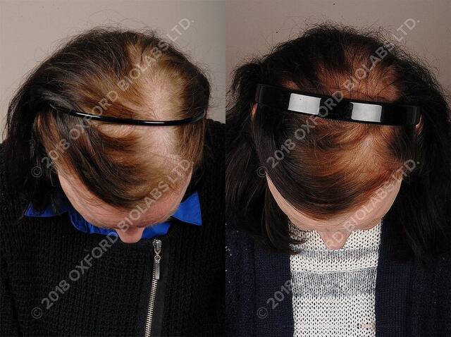 TRX2® before and after results