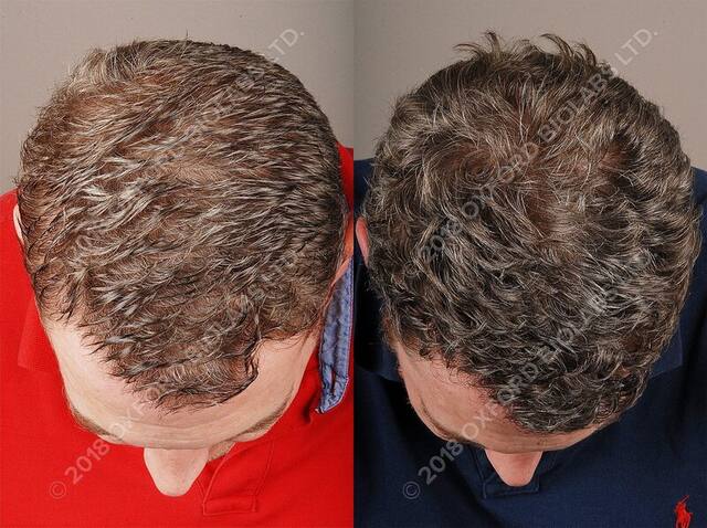 TRX2® before and after results
