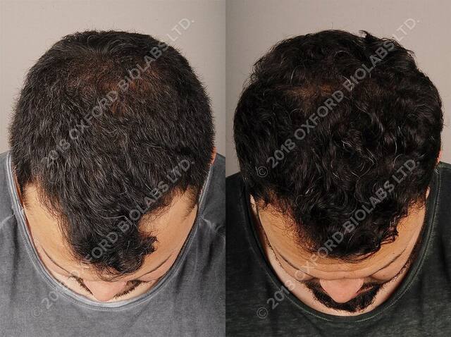 TRX2® before and after results