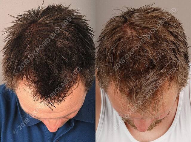 TRX2® before and after results