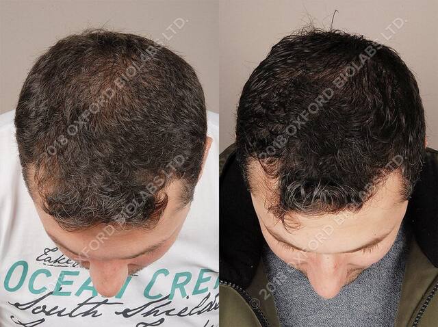 TRX2® before and after results